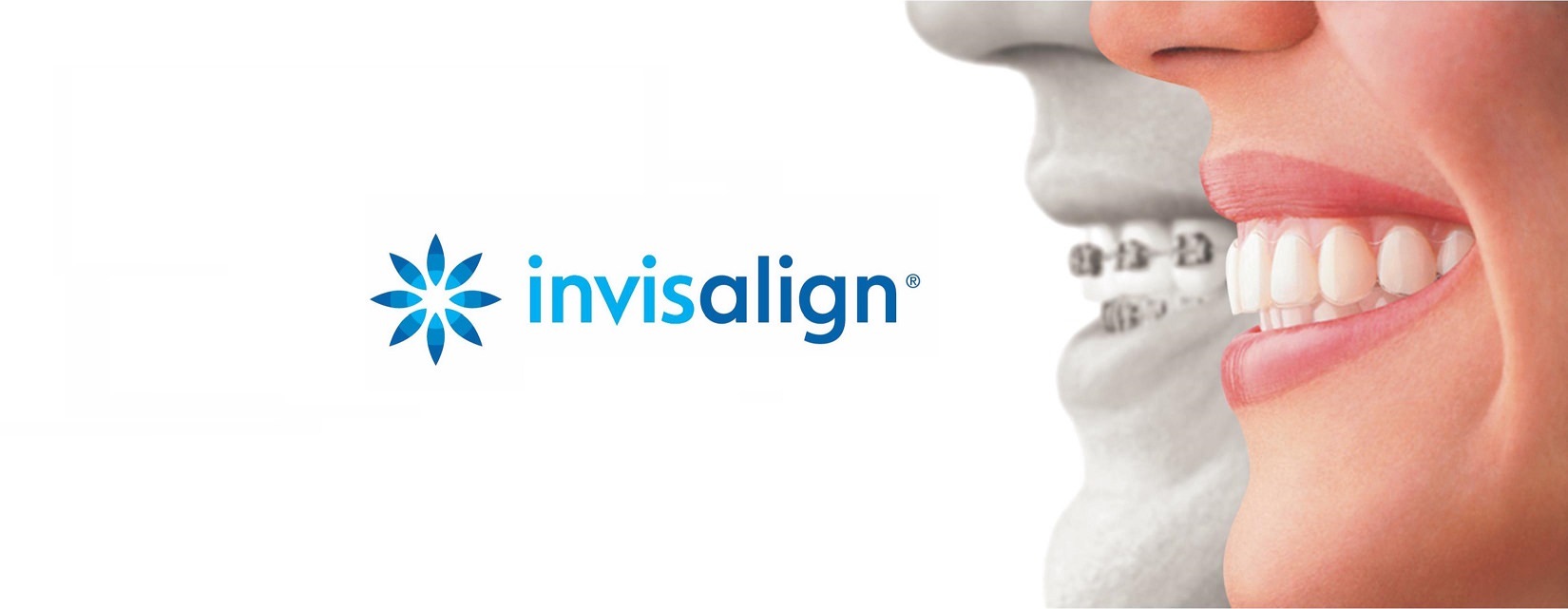 Invisalign StJérôme Dr Pierre Messier Orthodontiste