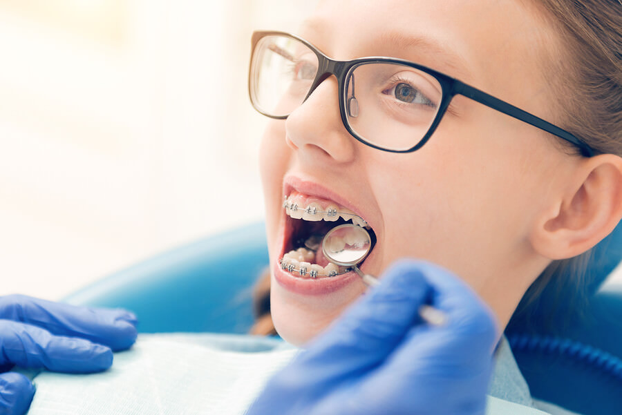Orthodontie pour adolescents 2| Dr Pierre Messier Orthodontiste St-Jérôme