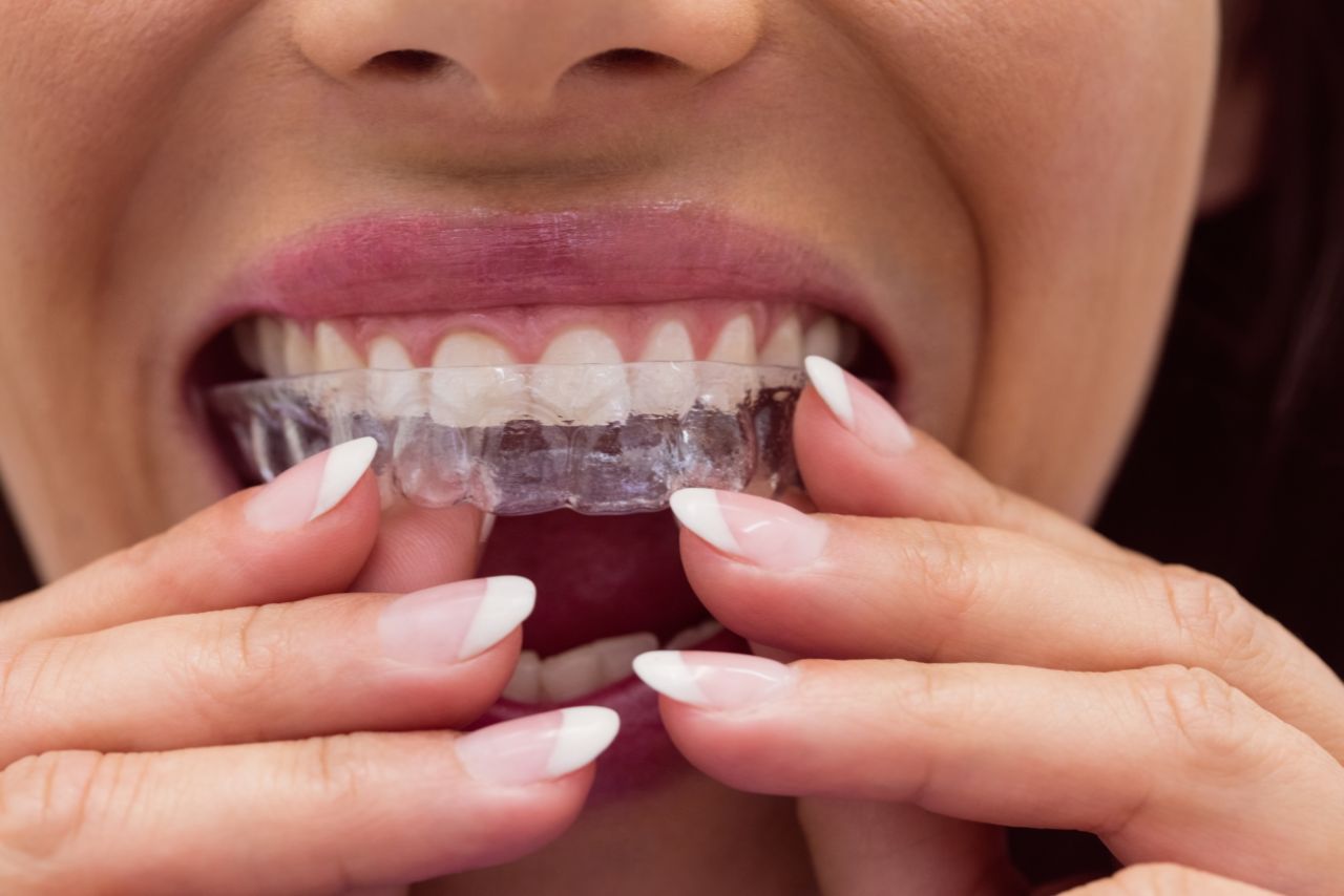 Pourquoi consulter un orthodontiste vs un dentiste généraliste - Clinique d'orthodontie Pierre Messier à St-Jérôme